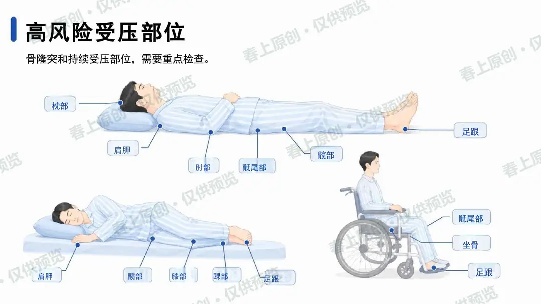 压力性损伤预防与护理管理预览第7页